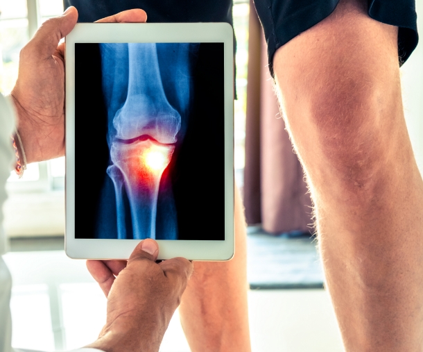 Arthritis & Joint Pain | Ortho Precision | Dr Yas Edirisinghe